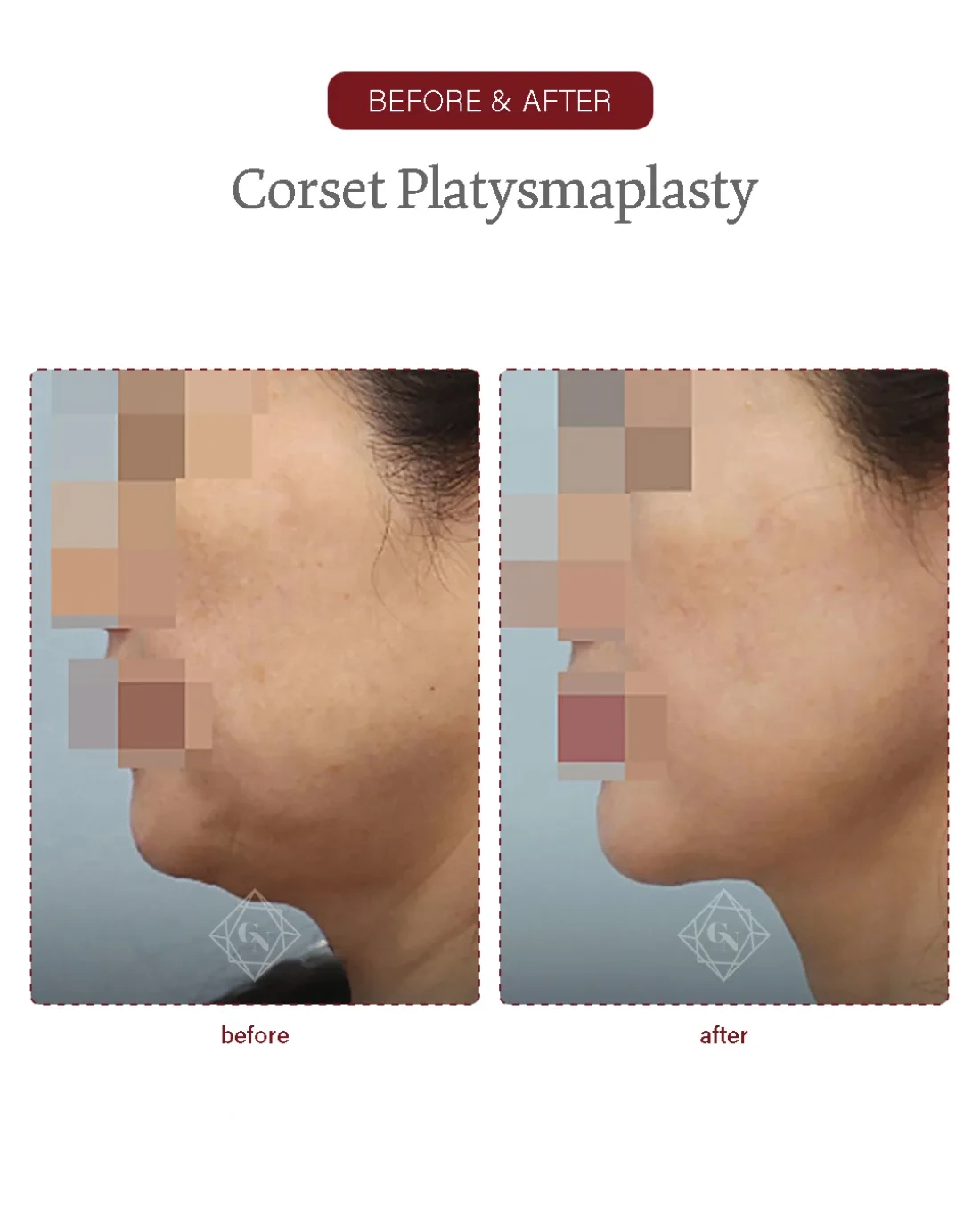 Before and after Corset Platysmaplasty at Garnet Plastic Surgery, Apgujeong Seoul — actual patient