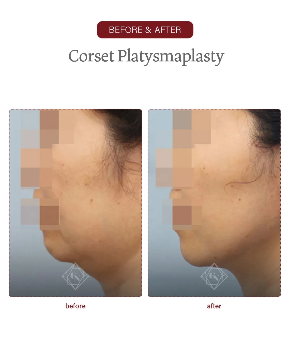Before and after Corset Platysmaplasty at Garnet Plastic Surgery, Apgujeong Seoul — actual patient