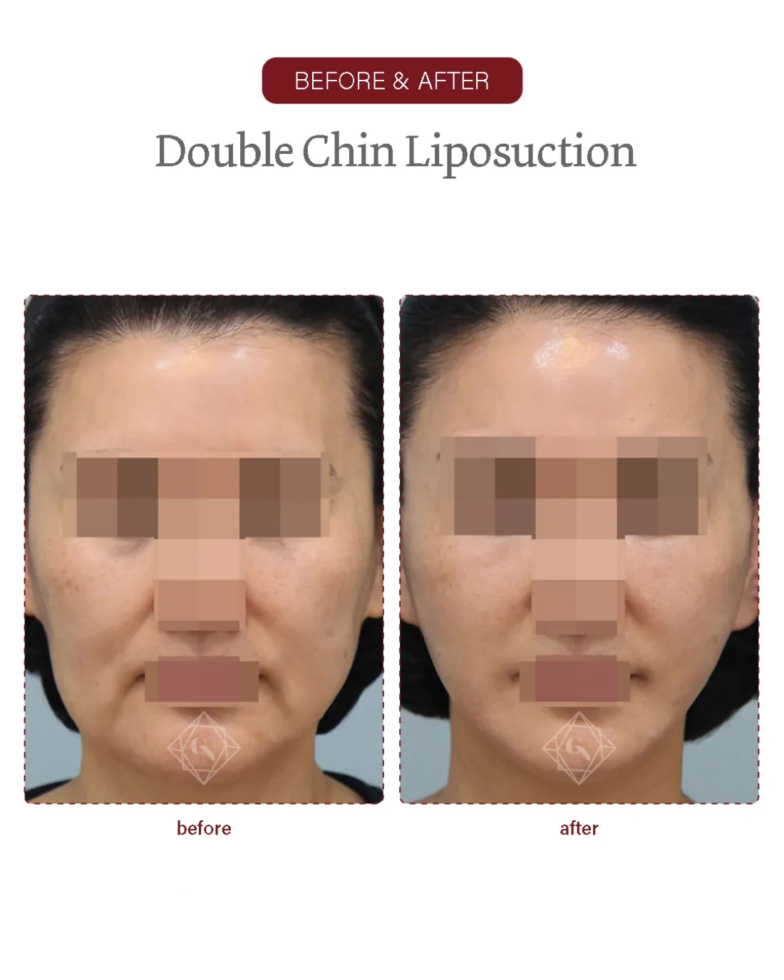 Before and after Double-chin Liposuction at Garnet Plastic Surgery, Apgujeong Seoul — actual patient