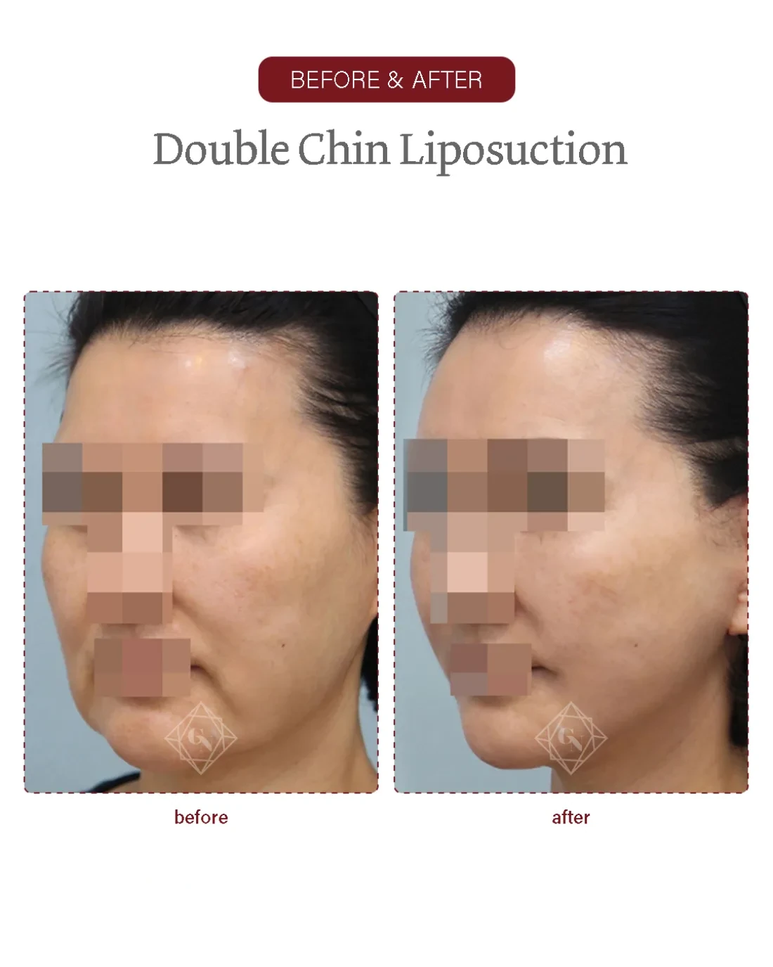 Before and after Double-chin Liposuction at Garnet Plastic Surgery, Apgujeong Seoul — actual patient