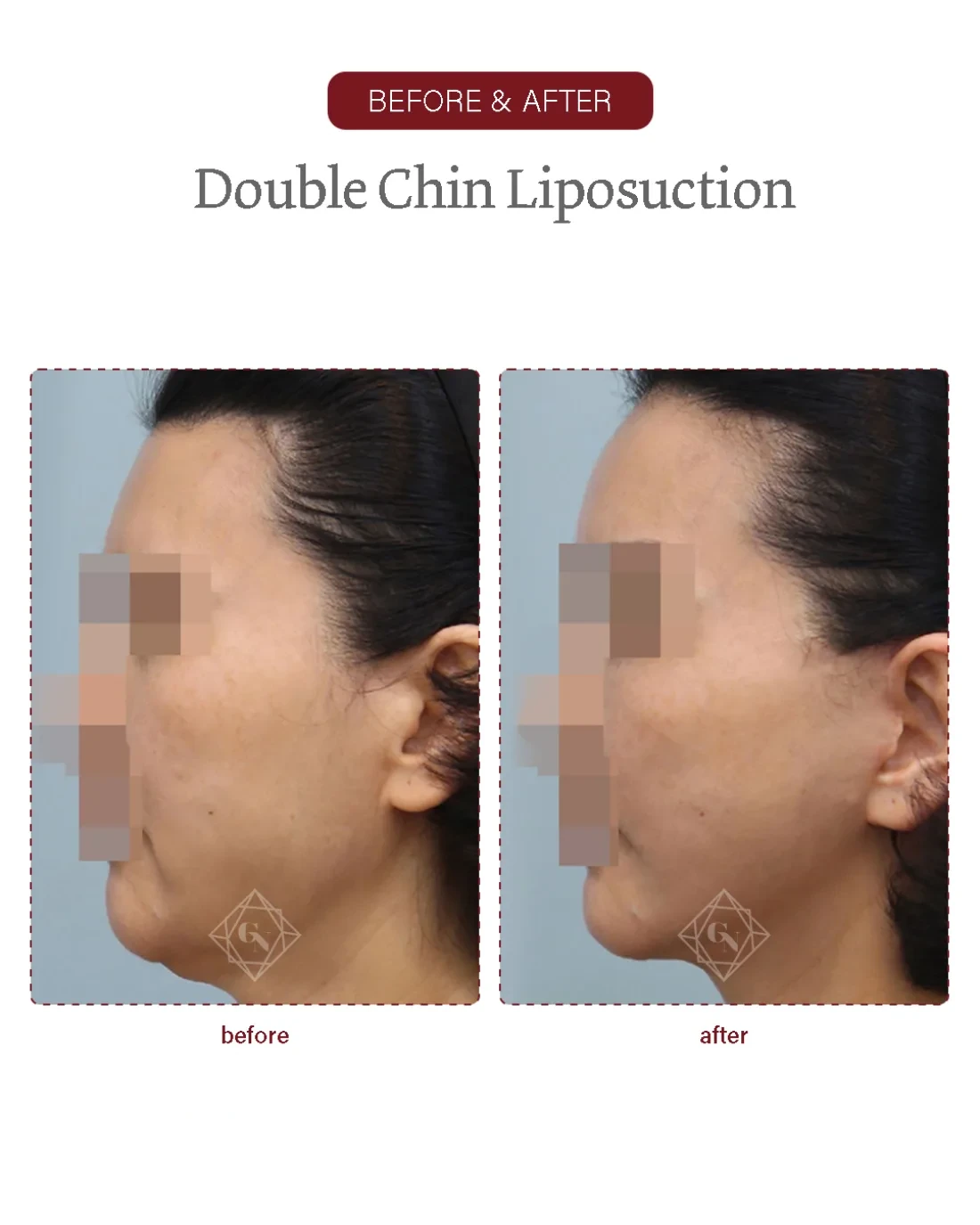 Before and after Double-chin Liposuction at Garnet Plastic Surgery, Apgujeong Seoul — actual patient