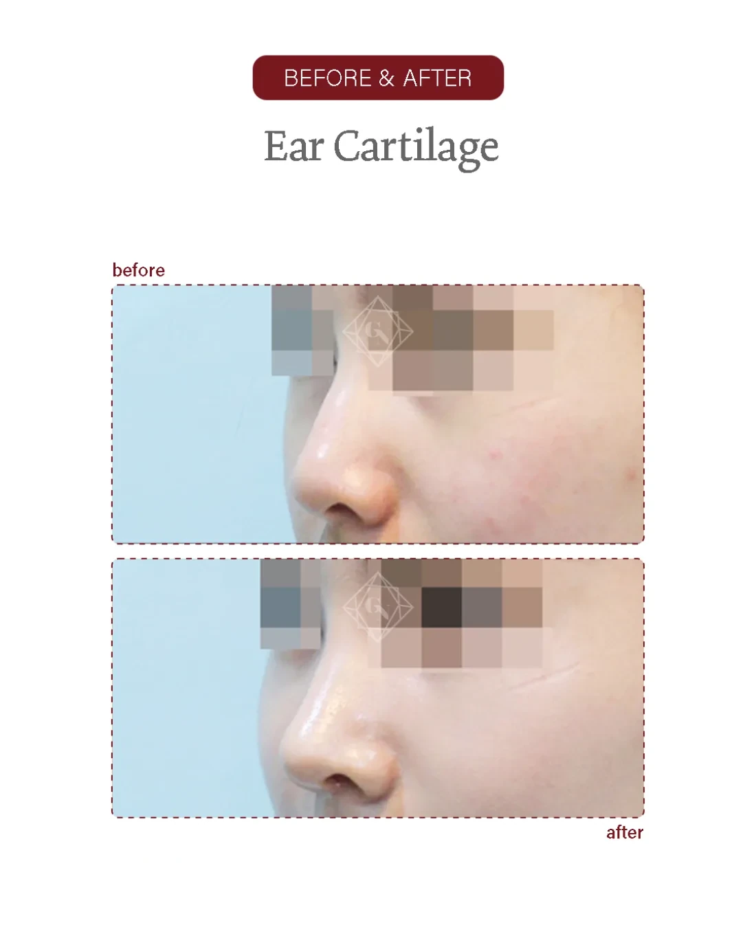 Before and after Ear-cartilage Rhinoplasty at Garnet Plastic Surgery, Apgujeong Seoul — actual patient