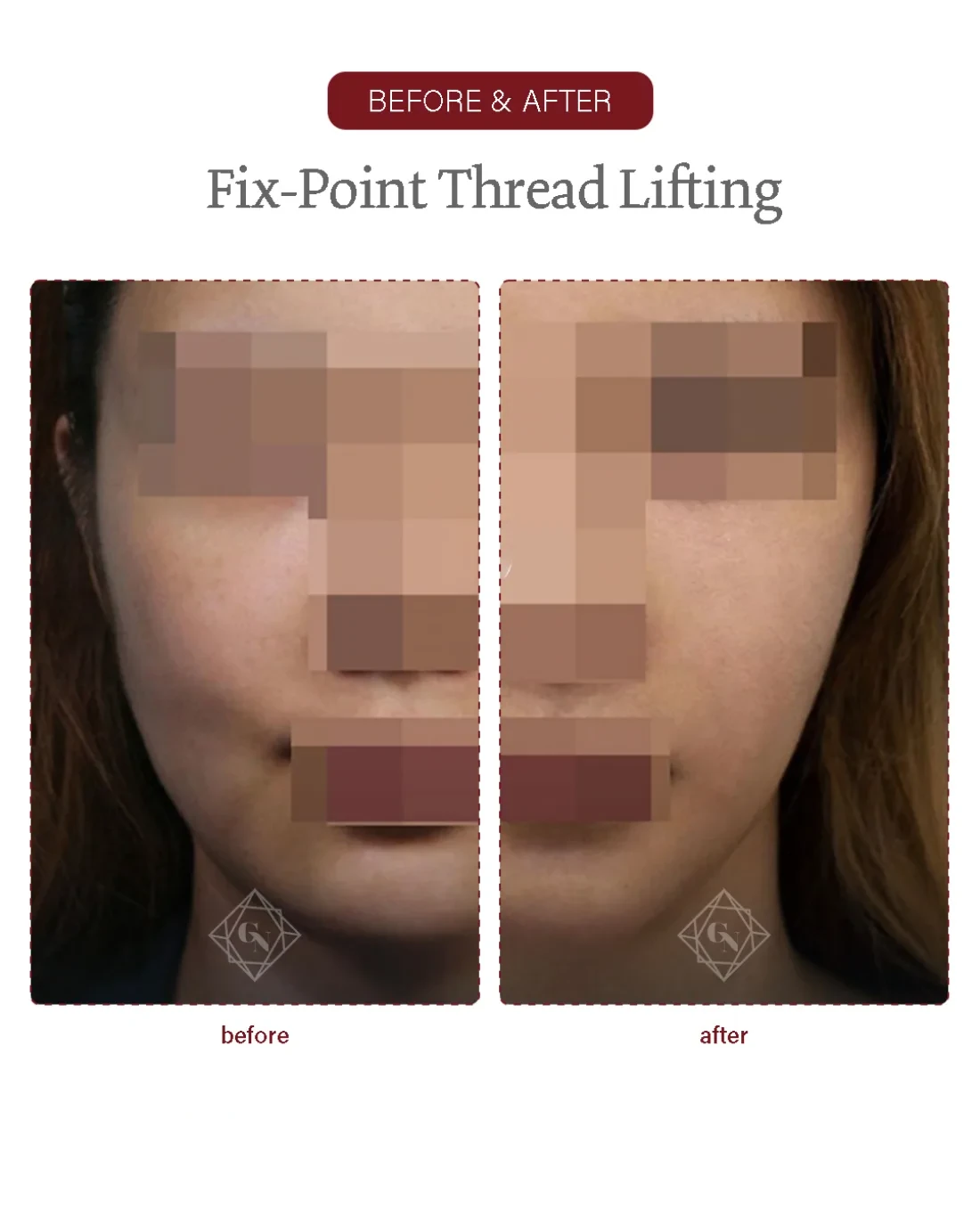 Before and after Fixpoint Thread Lift at Garnet Plastic Surgery, Apgujeong Seoul — actual patient