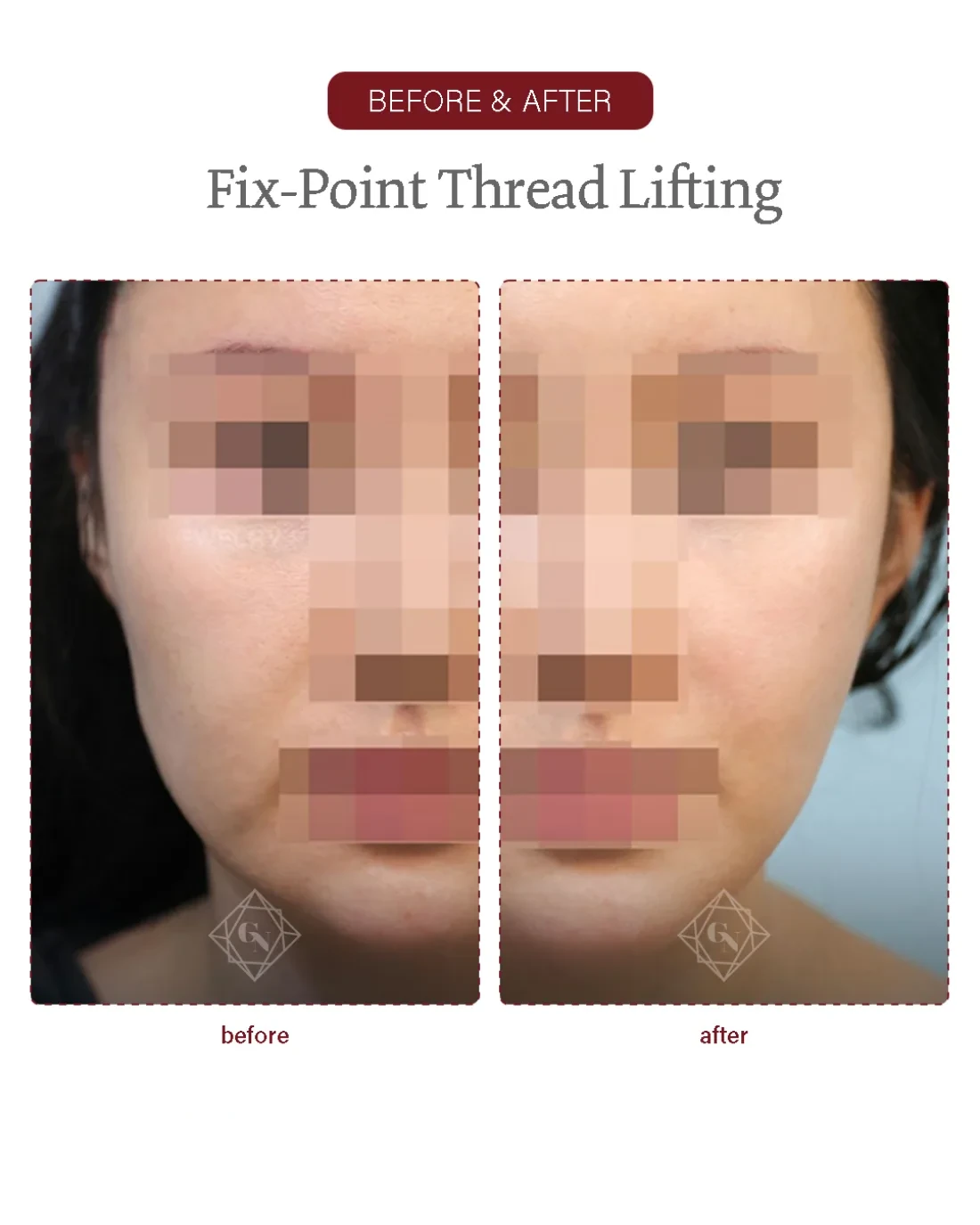 Before and after Fixpoint Thread Lift at Garnet Plastic Surgery, Apgujeong Seoul — actual patient