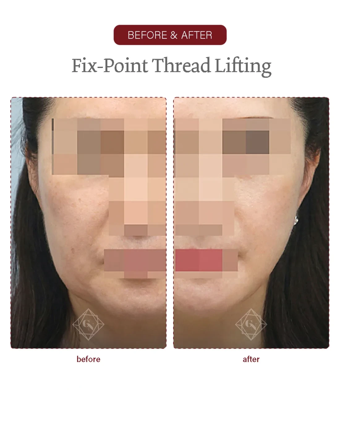 Before and after Fixpoint Thread Lift at Garnet Plastic Surgery, Apgujeong Seoul — actual patient