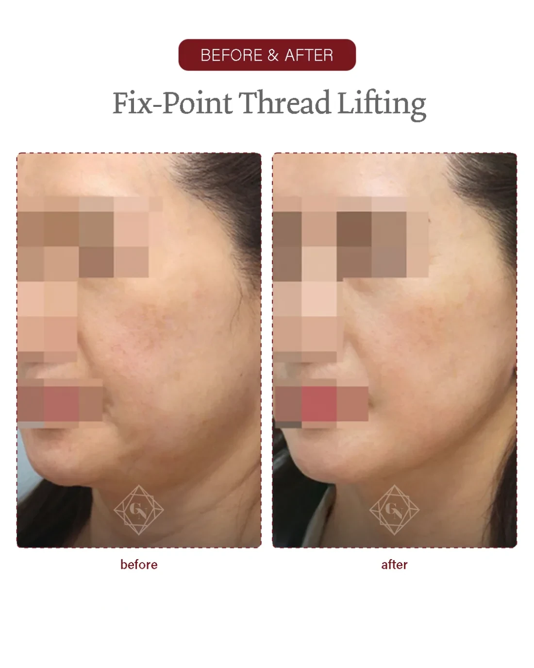 Before and after Fixpoint Thread Lift at Garnet Plastic Surgery, Apgujeong Seoul — actual patient