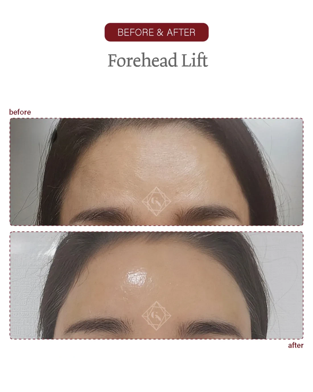 Before and after Forehead Reduction at Garnet Plastic Surgery, Apgujeong Seoul — actual patient