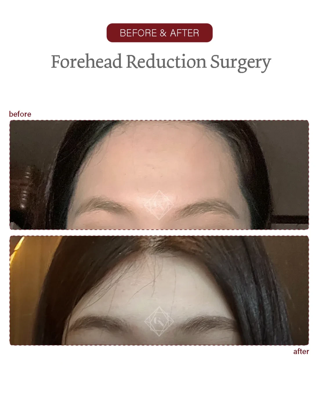 Before and after Forehead Reduction at Garnet Plastic Surgery, Apgujeong Seoul — actual patient