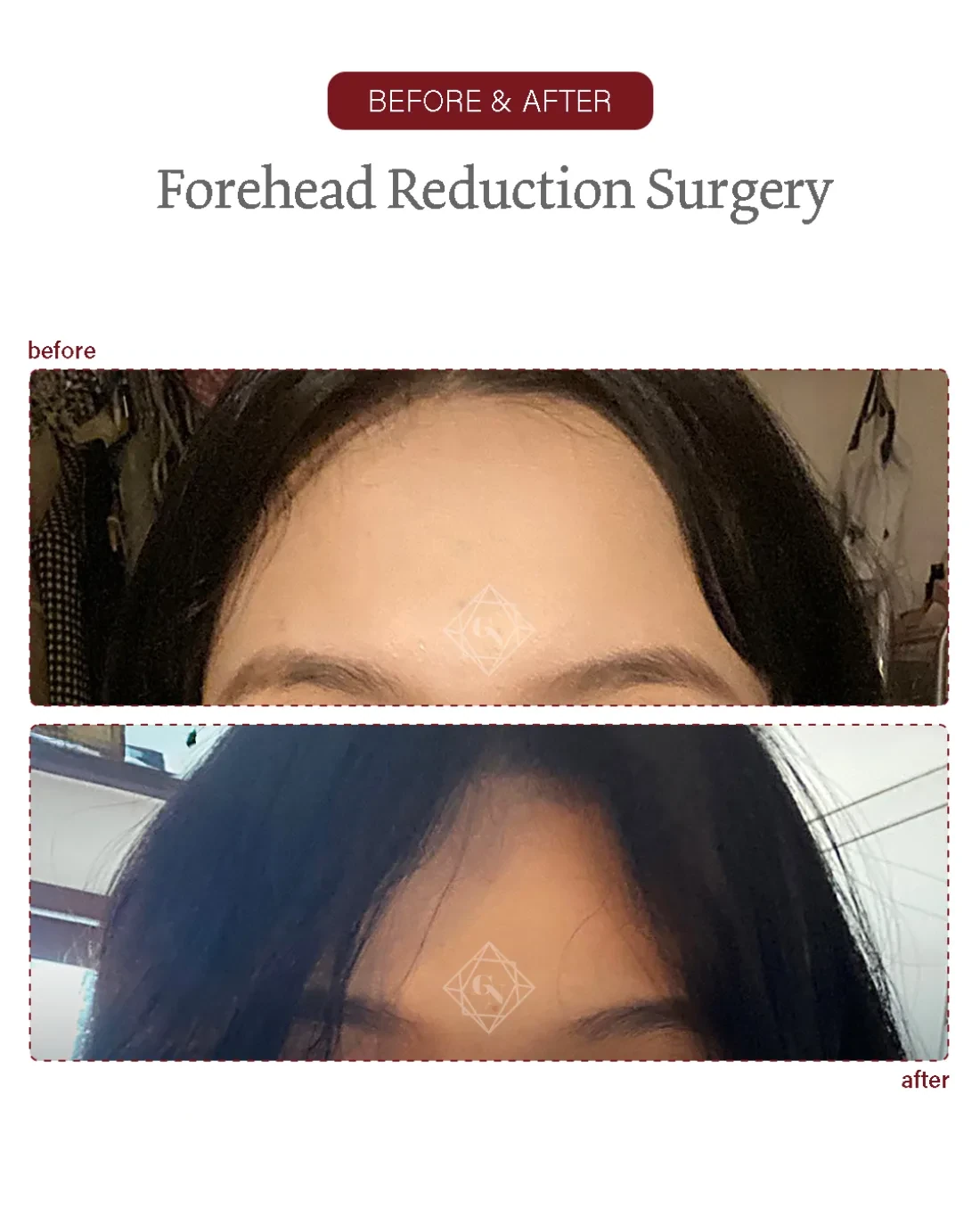 Before and after Forehead Reduction at Garnet Plastic Surgery, Apgujeong Seoul — actual patient