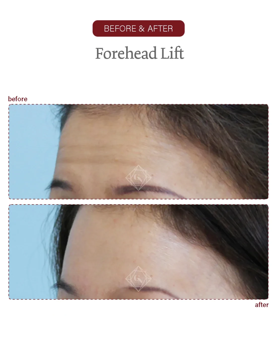 Before and after Forehead Reduction at Garnet Plastic Surgery, Apgujeong Seoul — actual patient