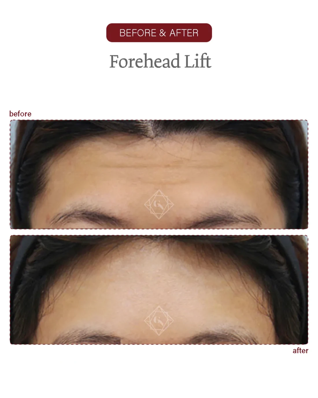 Before and after Forehead Reduction at Garnet Plastic Surgery, Apgujeong Seoul — actual patient