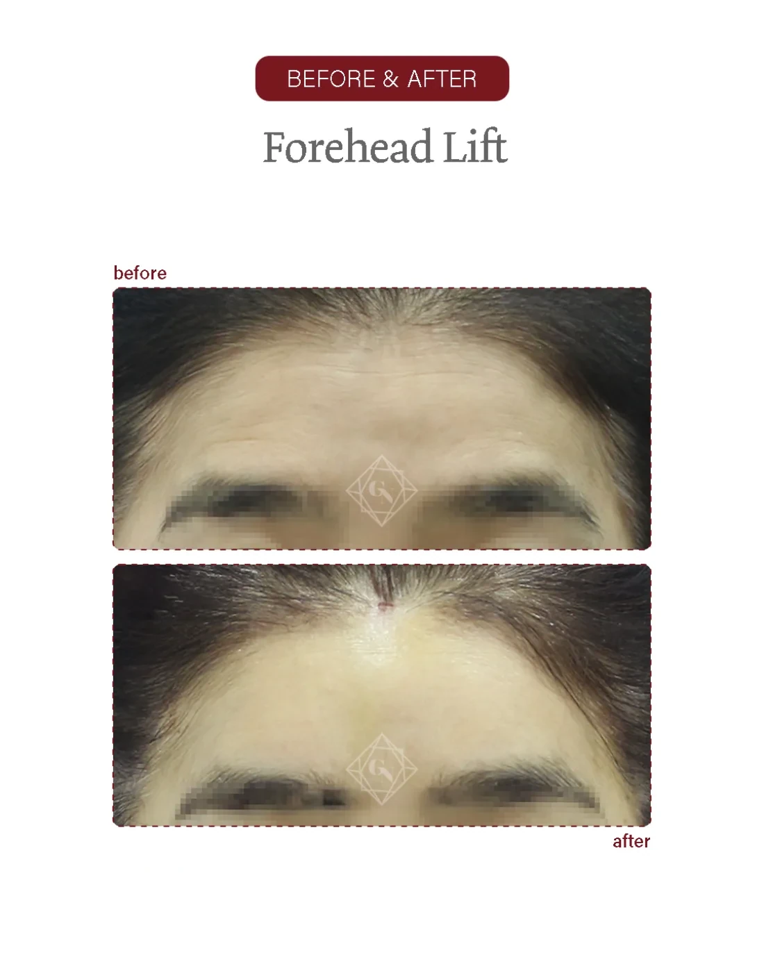Before and after Forehead Reduction at Garnet Plastic Surgery, Apgujeong Seoul — actual patient