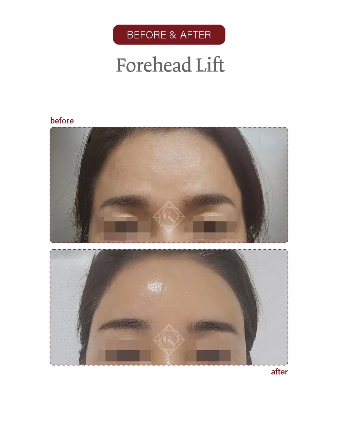 Before and after Forehead Reduction at Garnet Plastic Surgery, Apgujeong Seoul — actual patient