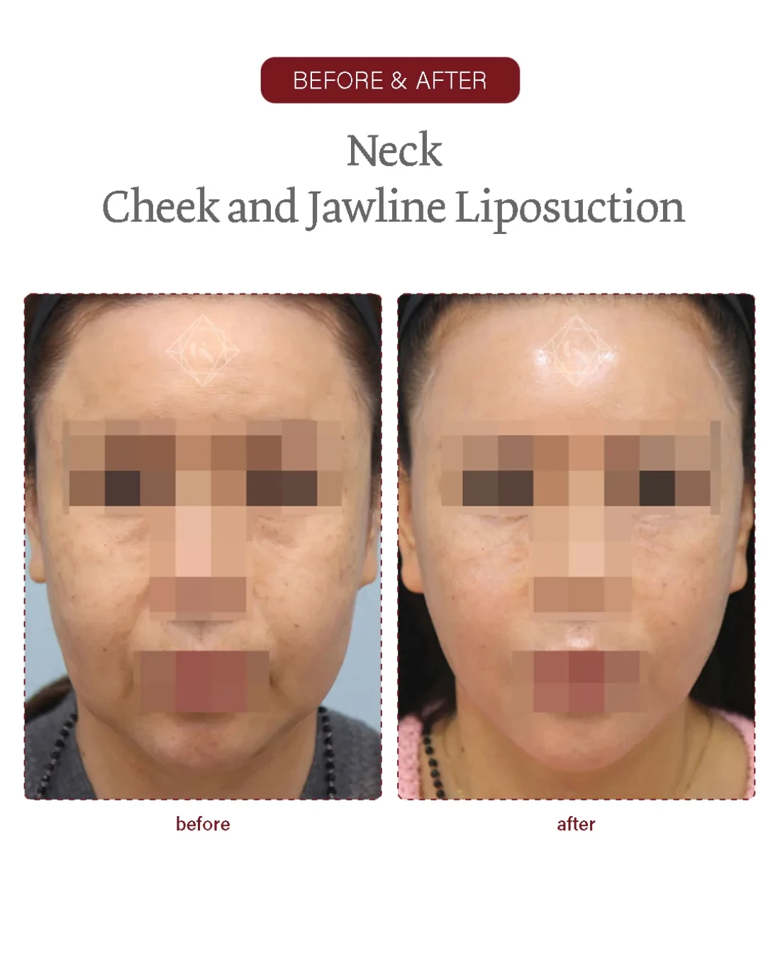 Before and after Neck / Jawline Liposuction at Garnet Plastic Surgery, Apgujeong Seoul — actual patient