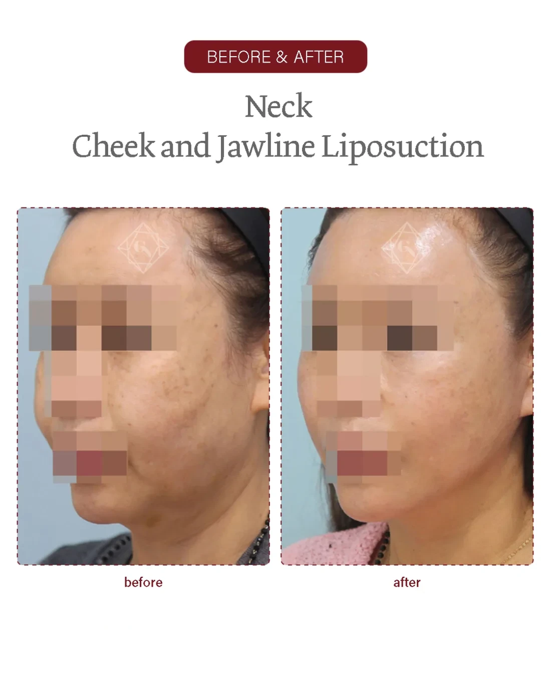 Before and after Neck / Jawline Liposuction at Garnet Plastic Surgery, Apgujeong Seoul — actual patient