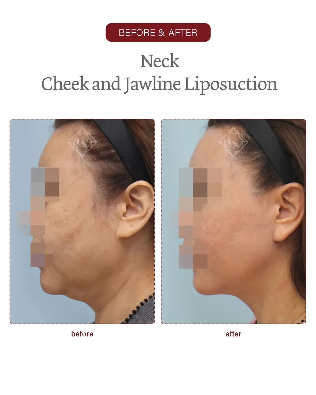 Before and after Neck / Jawline Liposuction at Garnet Plastic Surgery, Apgujeong Seoul — actual patient