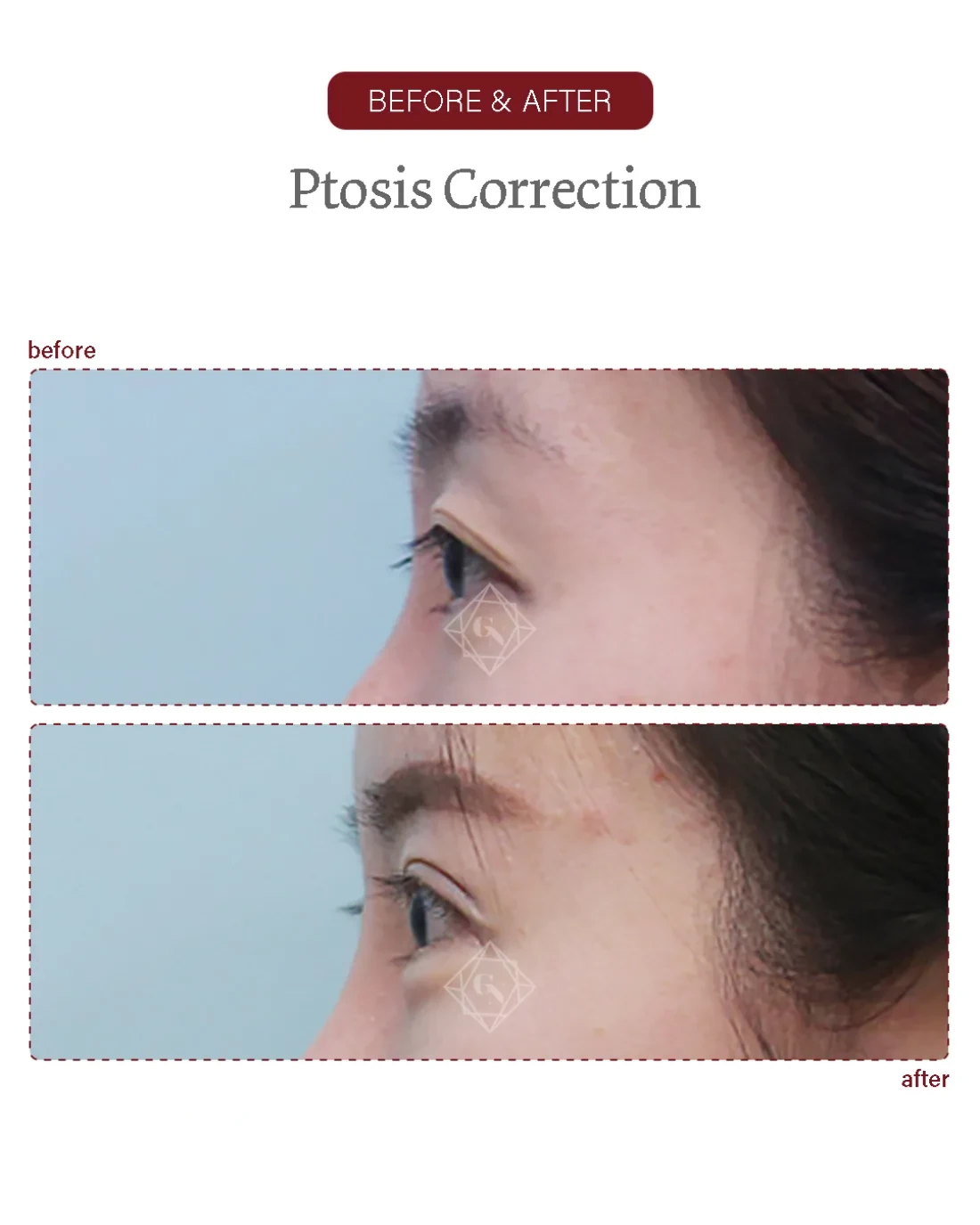 Before and after Ptosis Correction at Garnet Plastic Surgery, Apgujeong Seoul — actual patient