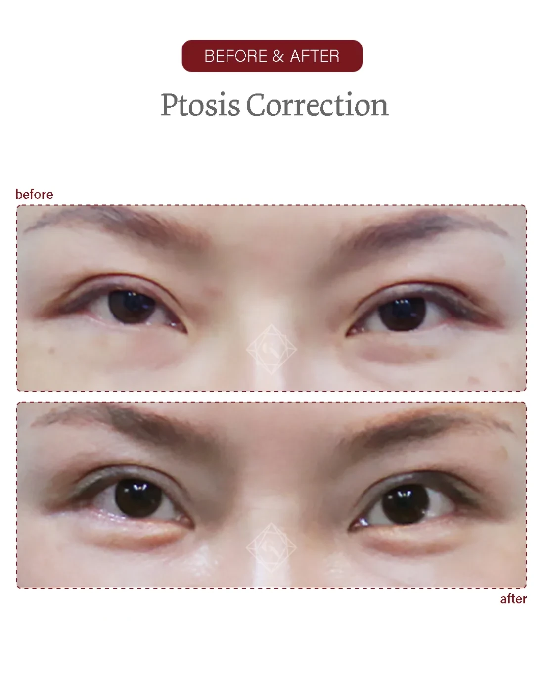 Before and after Ptosis Correction at Garnet Plastic Surgery, Apgujeong Seoul — actual patient