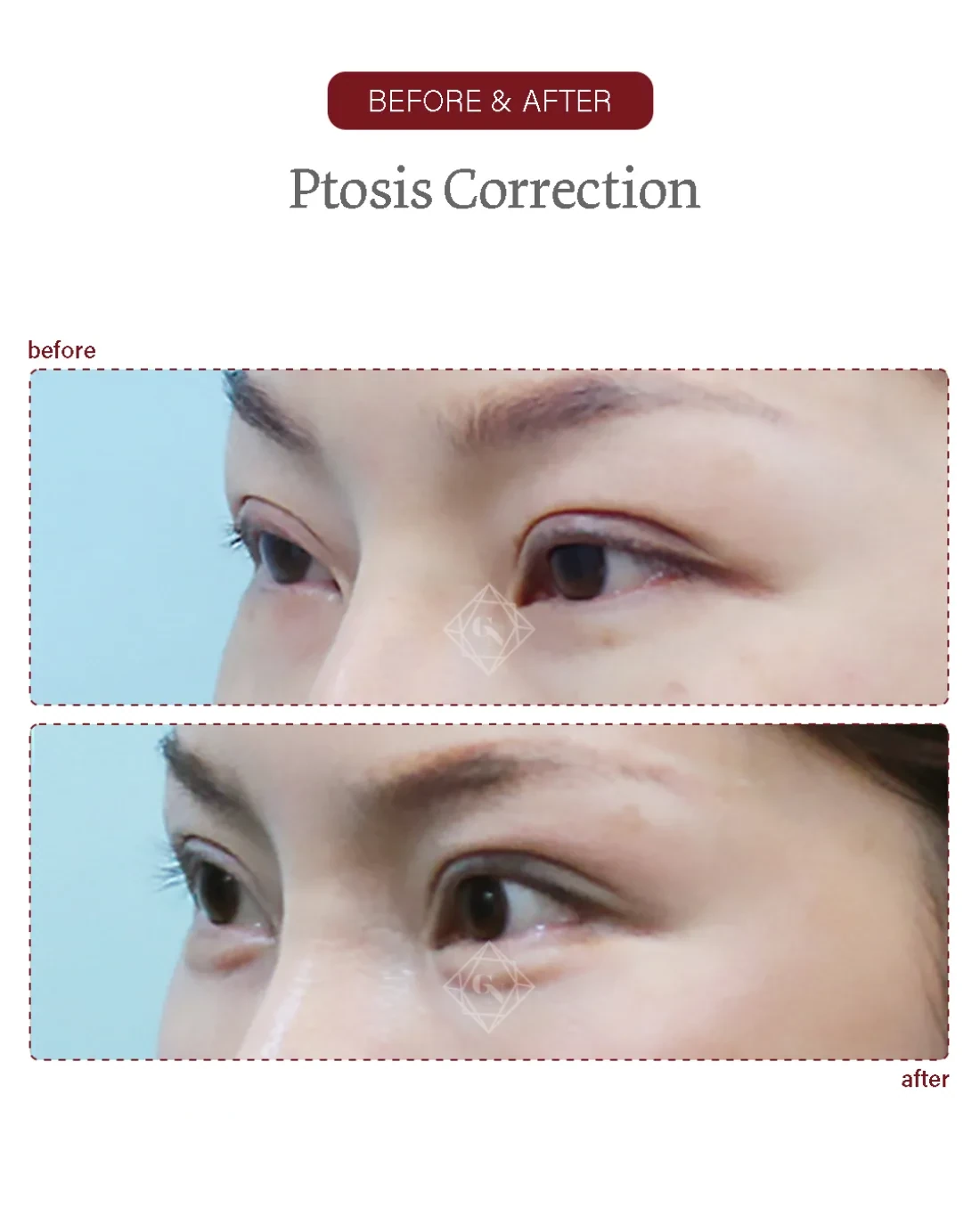 Before and after Ptosis Correction at Garnet Plastic Surgery, Apgujeong Seoul — actual patient