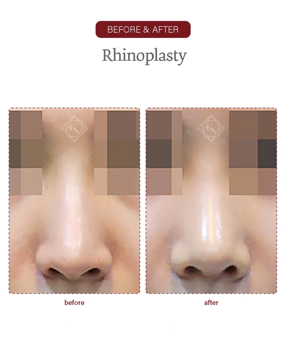 Before and after Rhinoplasty at Garnet Plastic Surgery, Apgujeong Seoul — actual patient