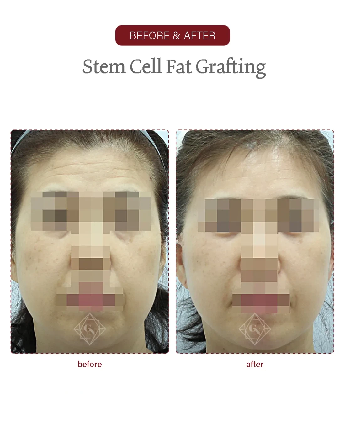 Before and after Stem-cell Fat Grafting at Garnet Plastic Surgery, Apgujeong Seoul — actual patient
