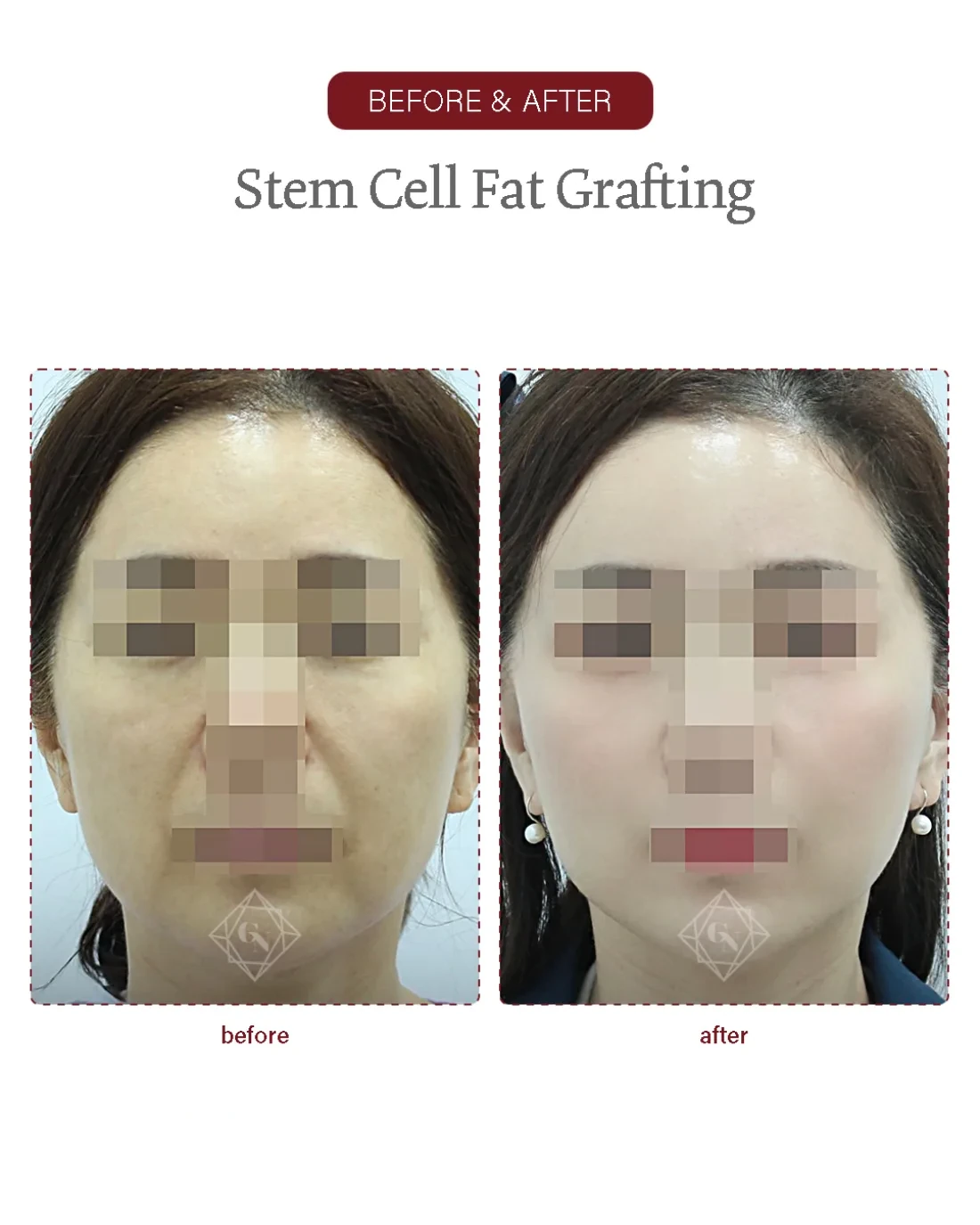 Before and after Stem-cell Fat Grafting at Garnet Plastic Surgery, Apgujeong Seoul — actual patient