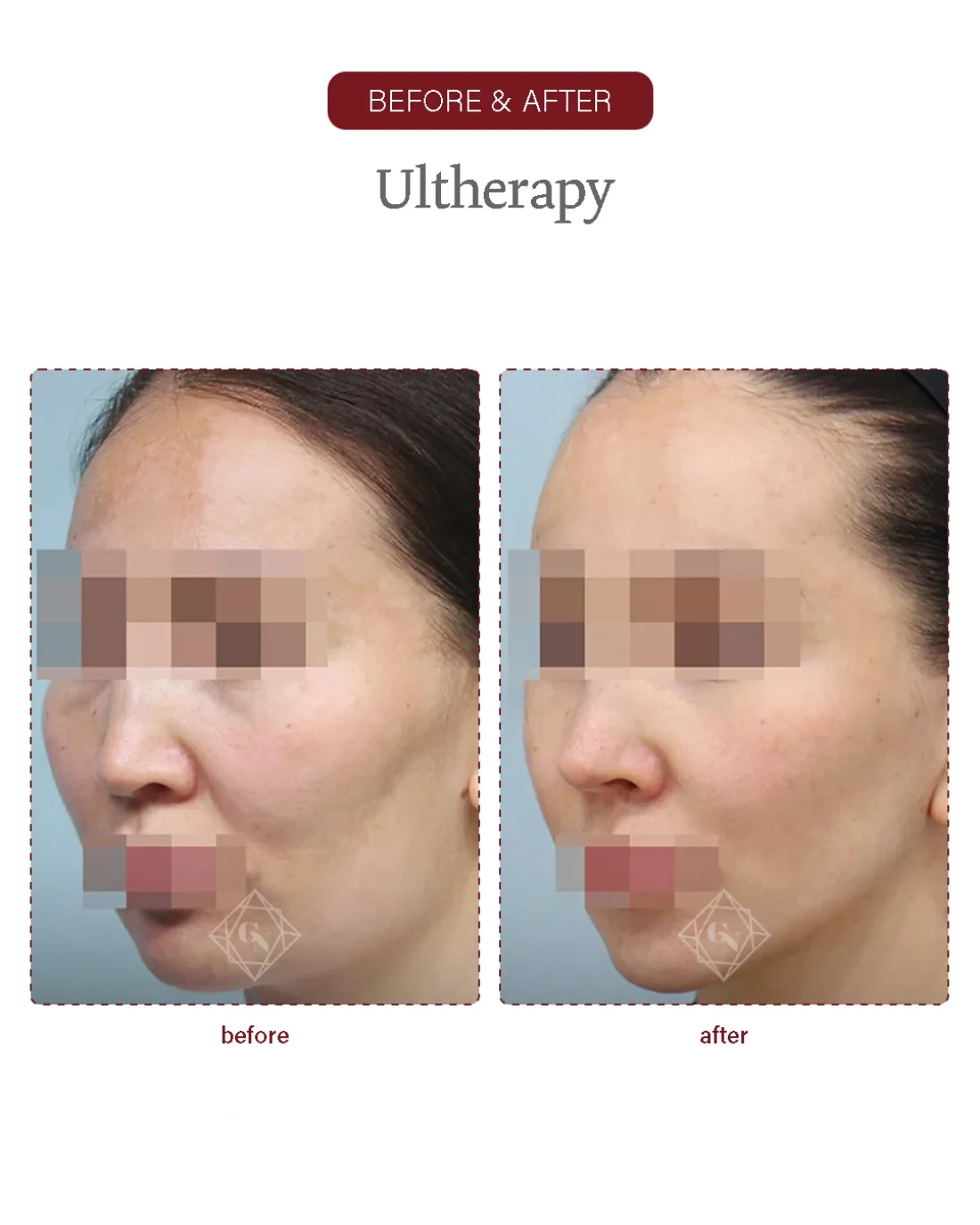 Before and after Ultherapy Lifting at Garnet Plastic Surgery, Apgujeong Seoul — actual patient