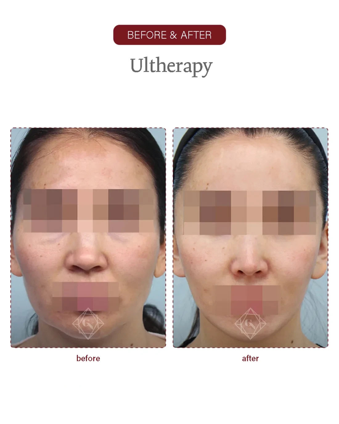 Before and after Ultherapy Lifting at Garnet Plastic Surgery, Apgujeong Seoul — actual patient