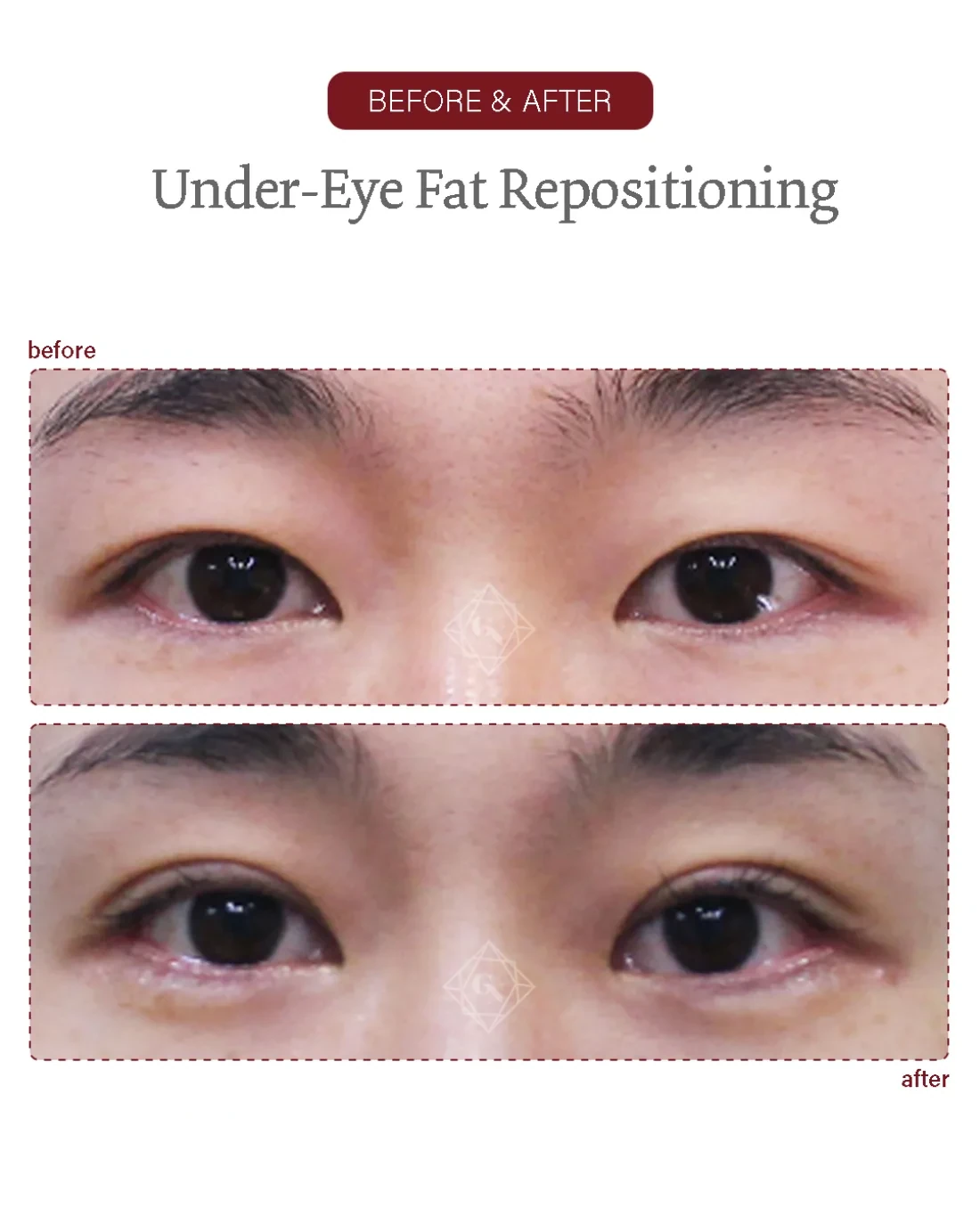 Before and after Under-eye Fat Repositioning at Garnet Plastic Surgery, Apgujeong Seoul — actual patient