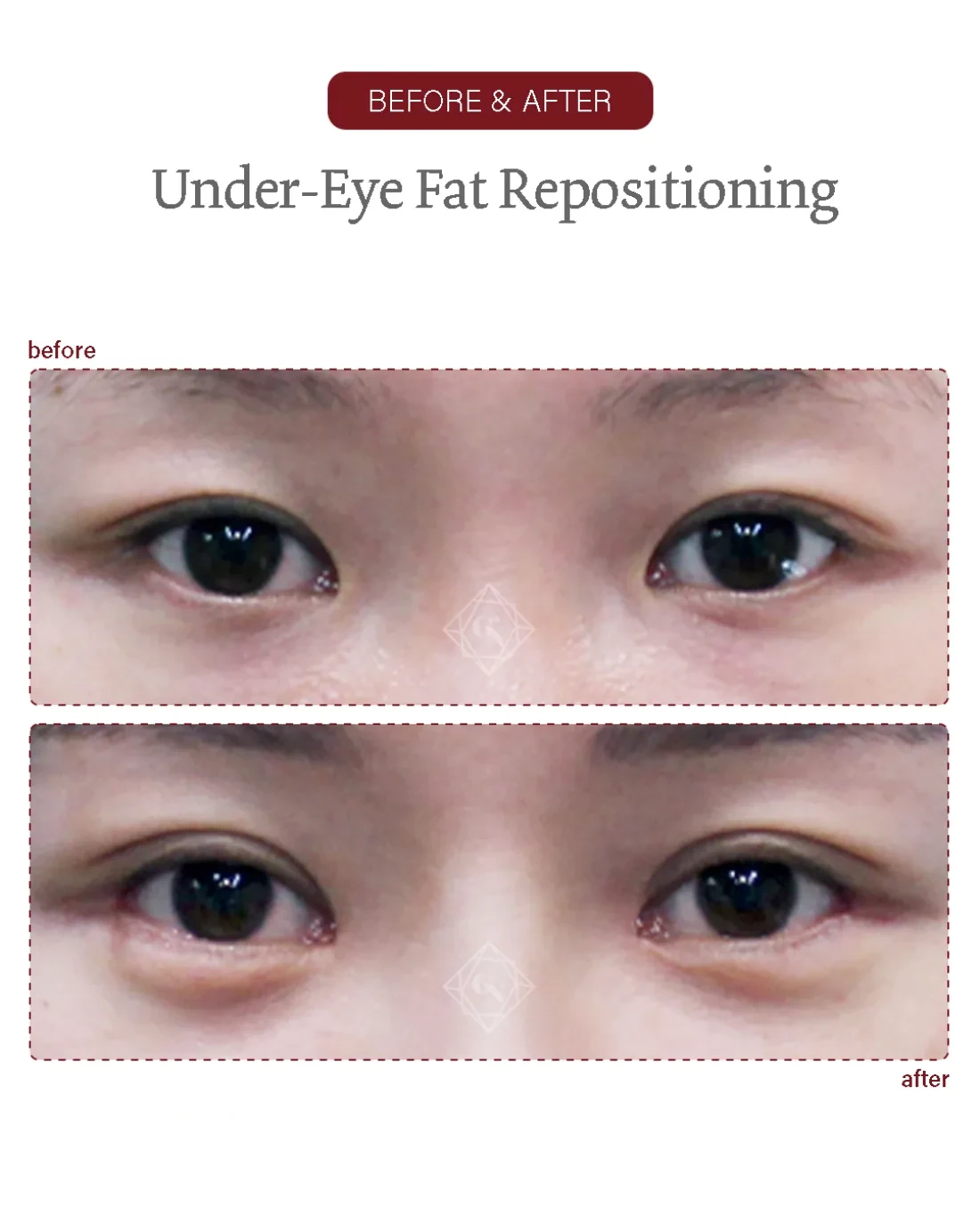 Before and after Under-eye Fat Repositioning at Garnet Plastic Surgery, Apgujeong Seoul — actual patient
