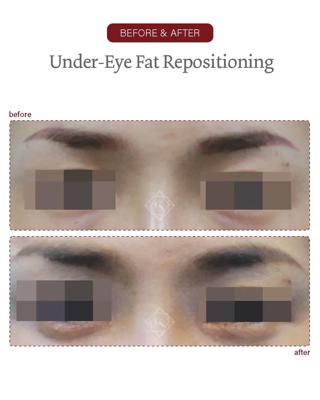 Before and after Under-eye Fat Repositioning at Garnet Plastic Surgery, Apgujeong Seoul — actual patient