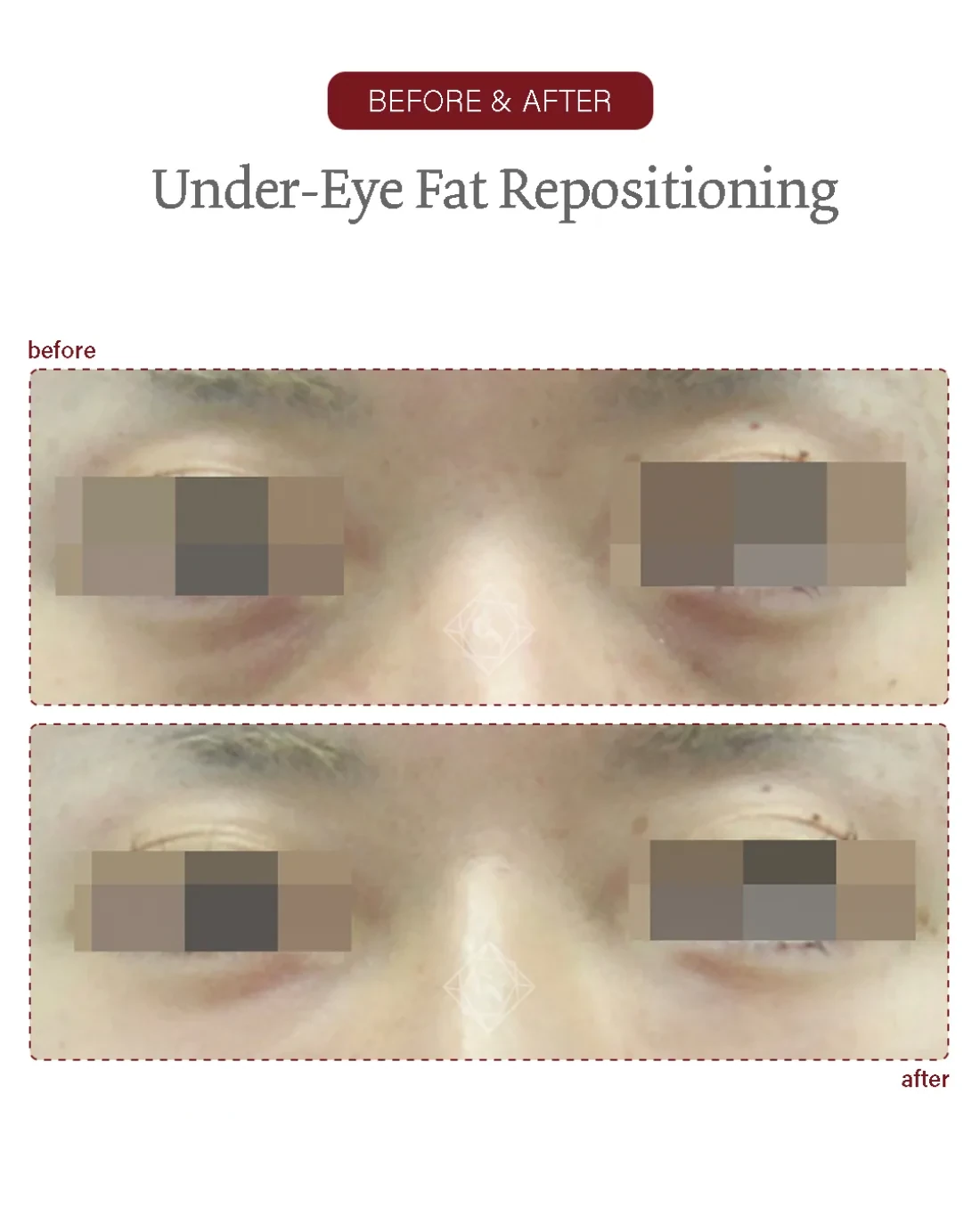 Before and after Under-eye Fat Repositioning at Garnet Plastic Surgery, Apgujeong Seoul — actual patient