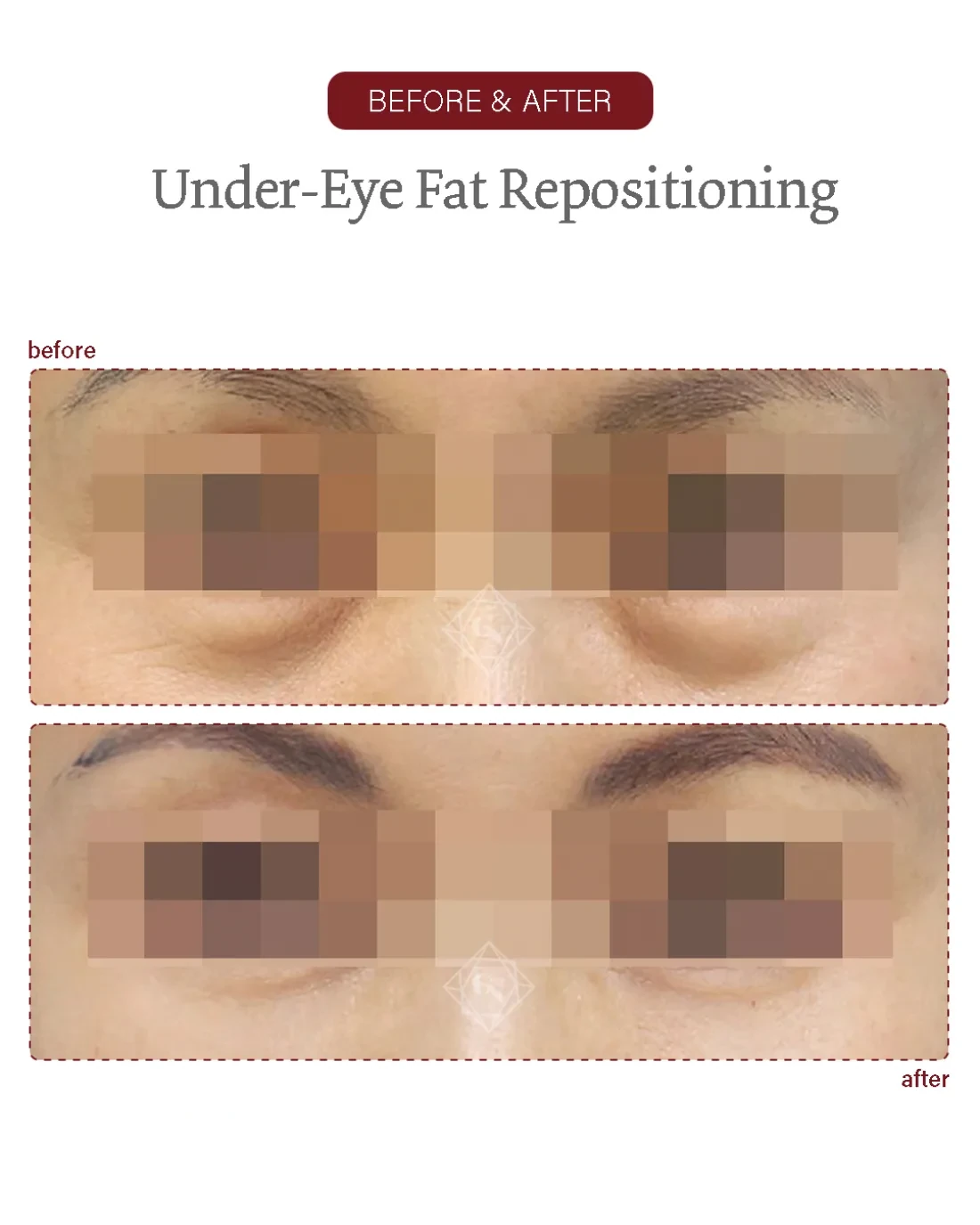 Before and after Under-eye Fat Repositioning at Garnet Plastic Surgery, Apgujeong Seoul — actual patient
