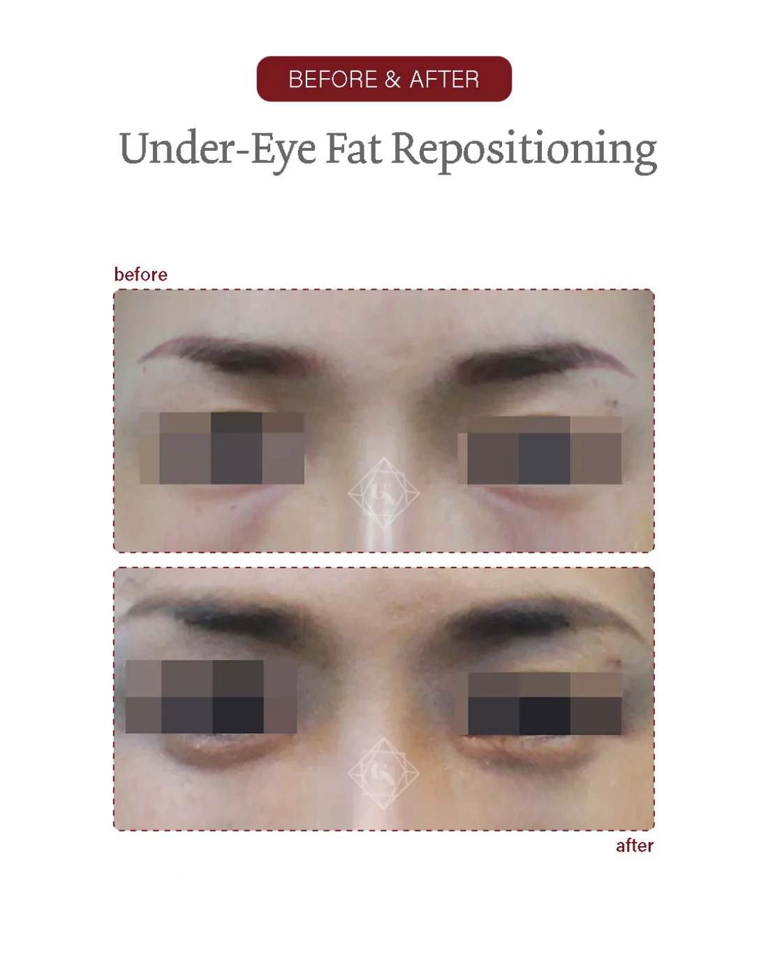 Before and after Under-eye Fat Repositioning at Garnet Plastic Surgery, Apgujeong Seoul — actual patient