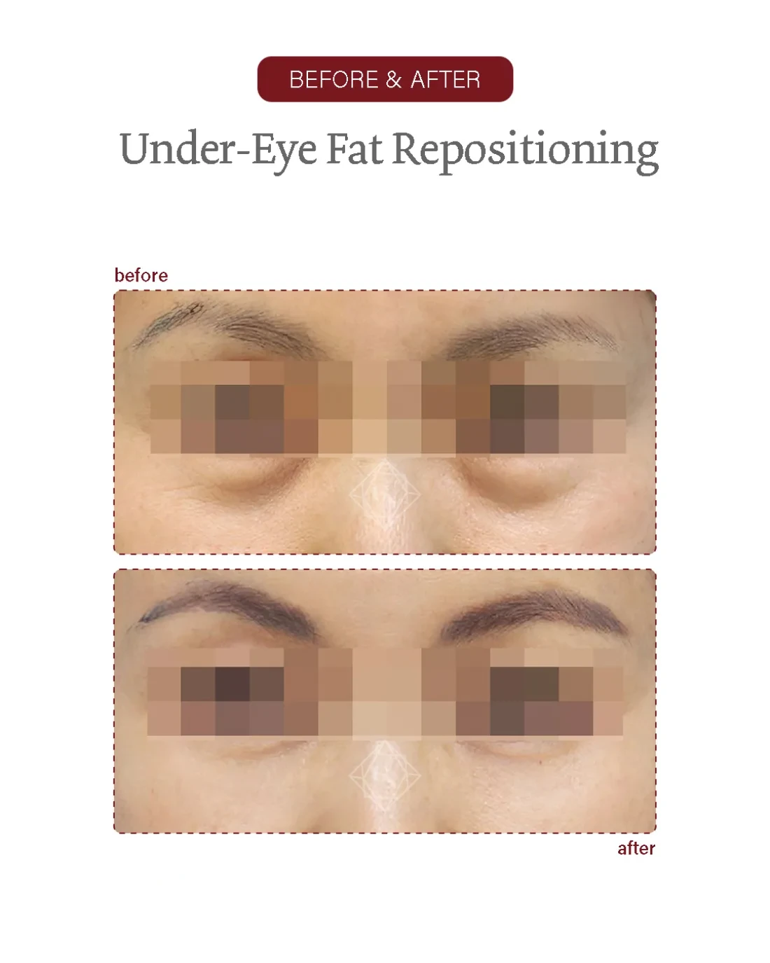 Before and after Under-eye Fat Repositioning at Garnet Plastic Surgery, Apgujeong Seoul — actual patient