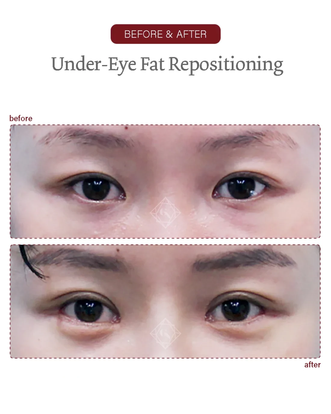 Before and after Under-eye Fat Repositioning at Garnet Plastic Surgery, Apgujeong Seoul — actual patient
