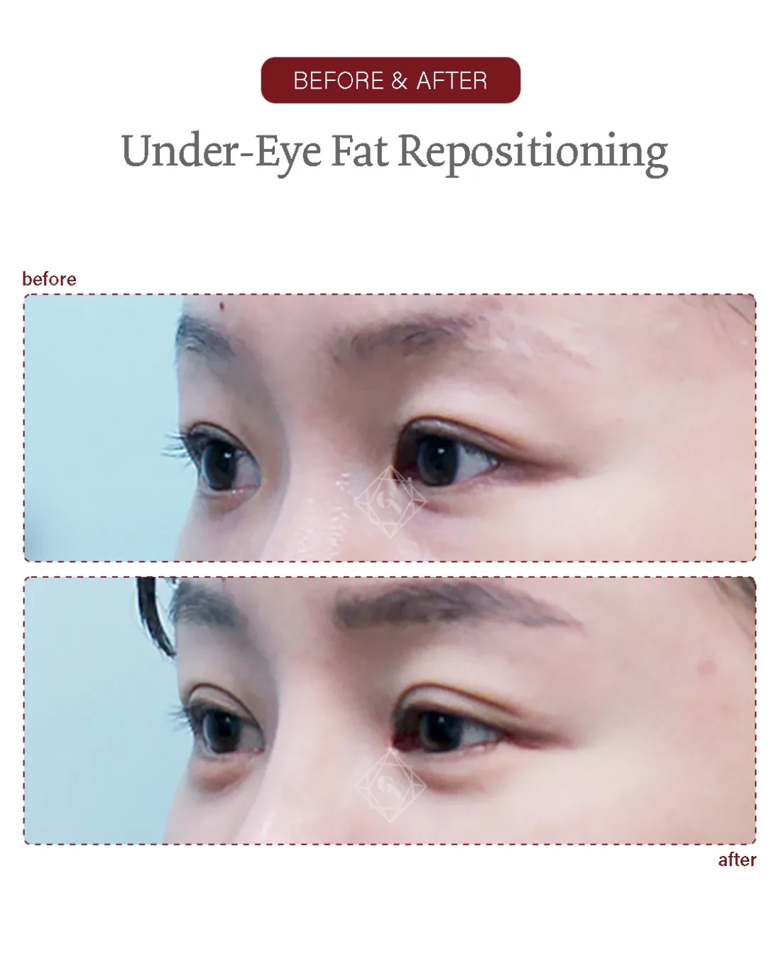 Before and after Under-eye Fat Repositioning at Garnet Plastic Surgery, Apgujeong Seoul — actual patient