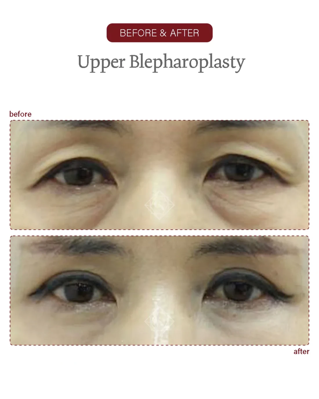 Before and after Upper & Lower Blepharoplasty at Garnet Plastic Surgery, Apgujeong Seoul — actual patient