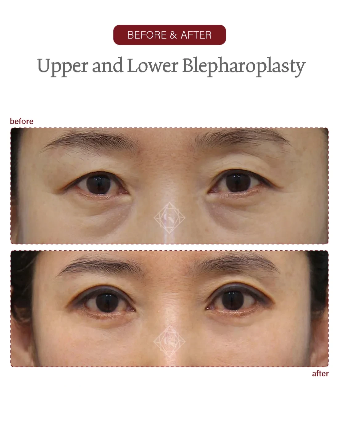 Before and after Upper & Lower Blepharoplasty at Garnet Plastic Surgery, Apgujeong Seoul — actual patient