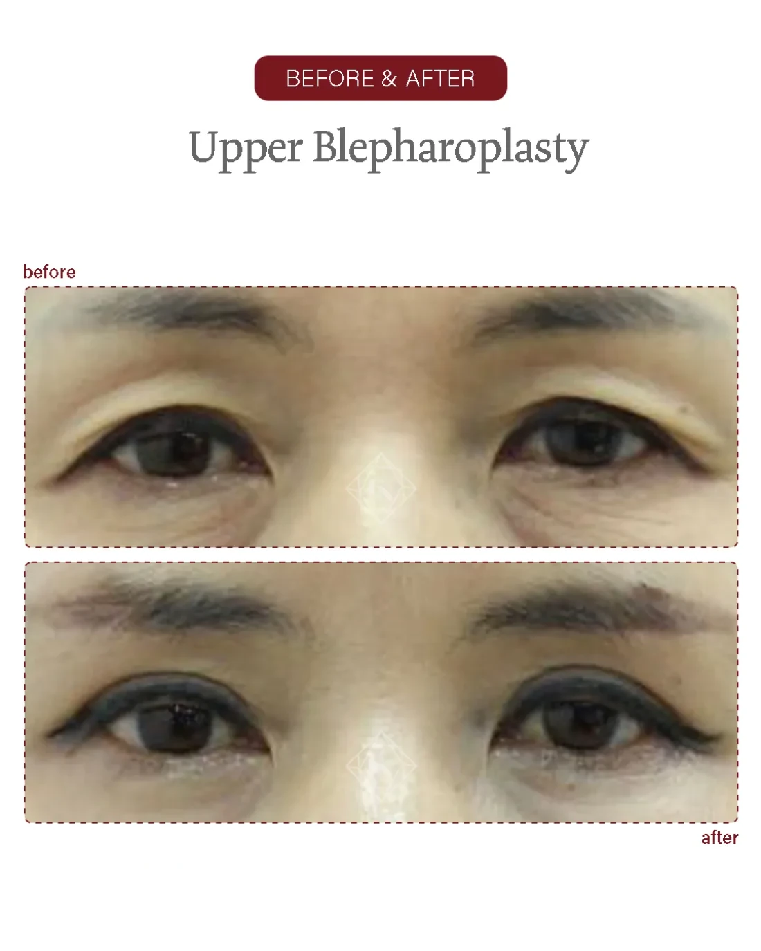 Before and after Upper & Lower Blepharoplasty at Garnet Plastic Surgery, Apgujeong Seoul — actual patient