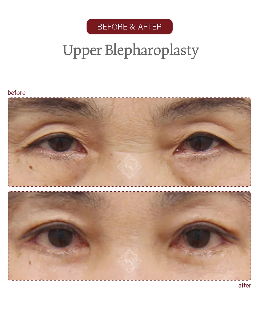 Before and after Upper & Lower Blepharoplasty at Garnet Plastic Surgery, Apgujeong Seoul — actual patient