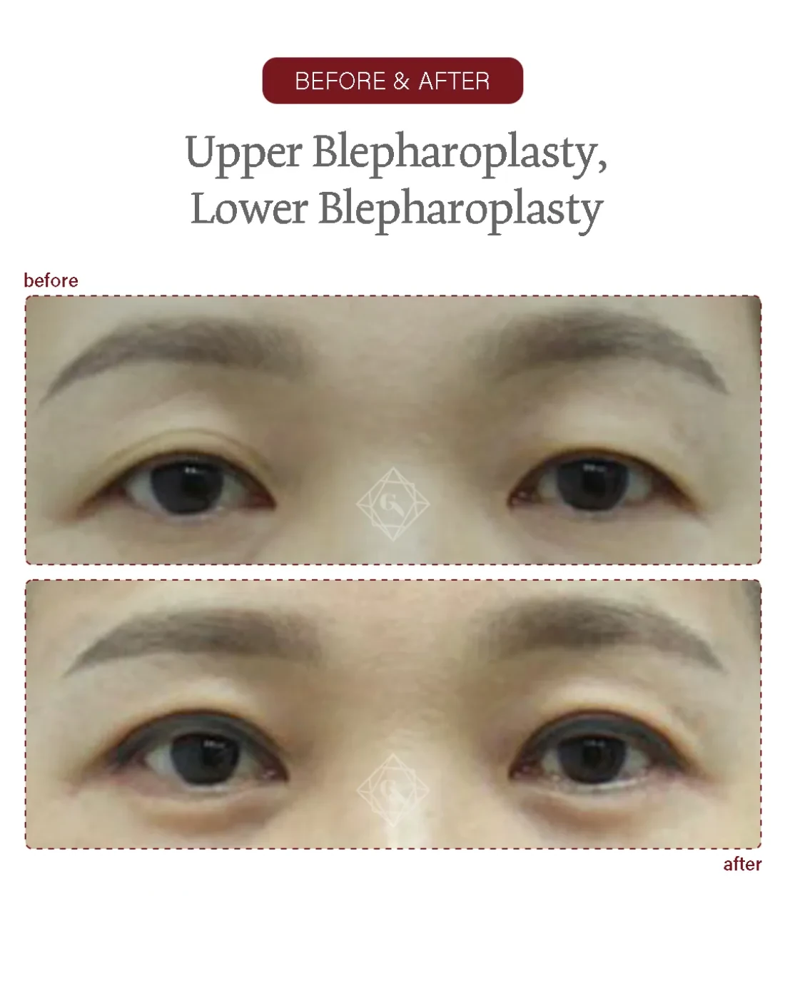 Before and after Upper & Lower Blepharoplasty at Garnet Plastic Surgery, Apgujeong Seoul — actual patient