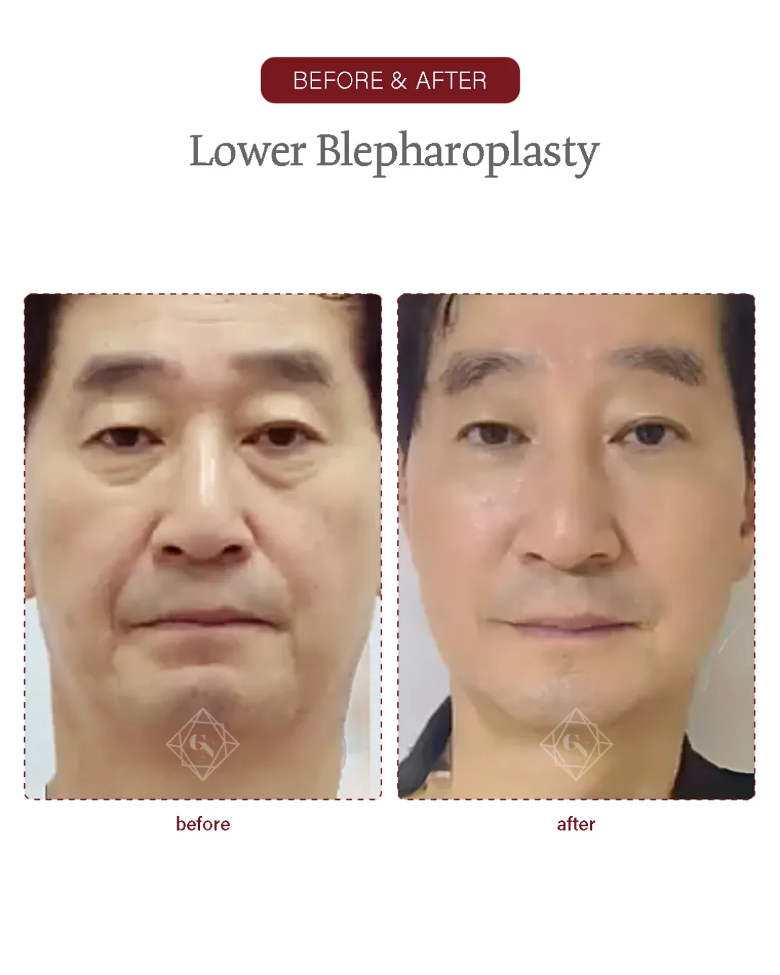 Before and after Upper & Lower Blepharoplasty at Garnet Plastic Surgery, Apgujeong Seoul — actual patient