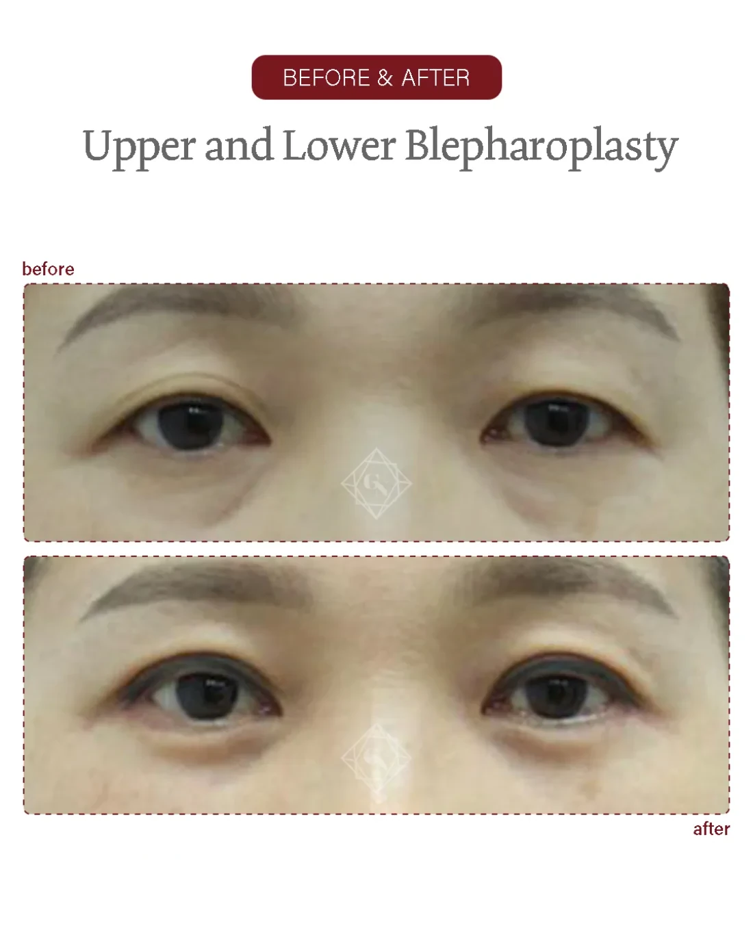 Before and after Upper & Lower Blepharoplasty at Garnet Plastic Surgery, Apgujeong Seoul — actual patient