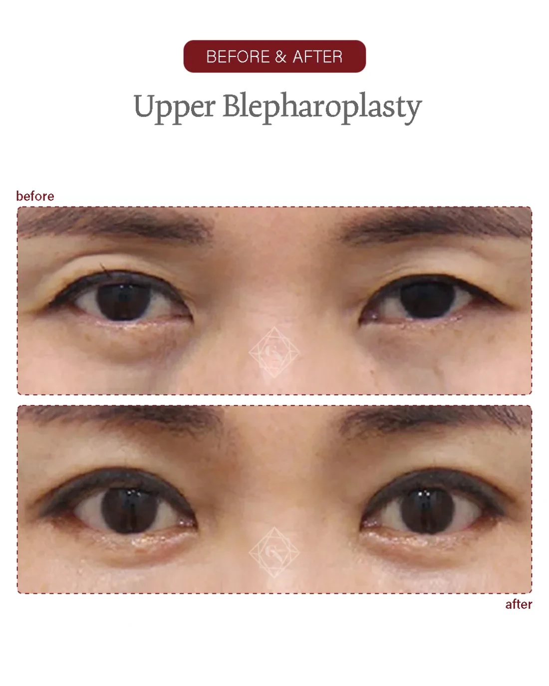Before and after Upper & Lower Blepharoplasty at Garnet Plastic Surgery, Apgujeong Seoul — actual patient