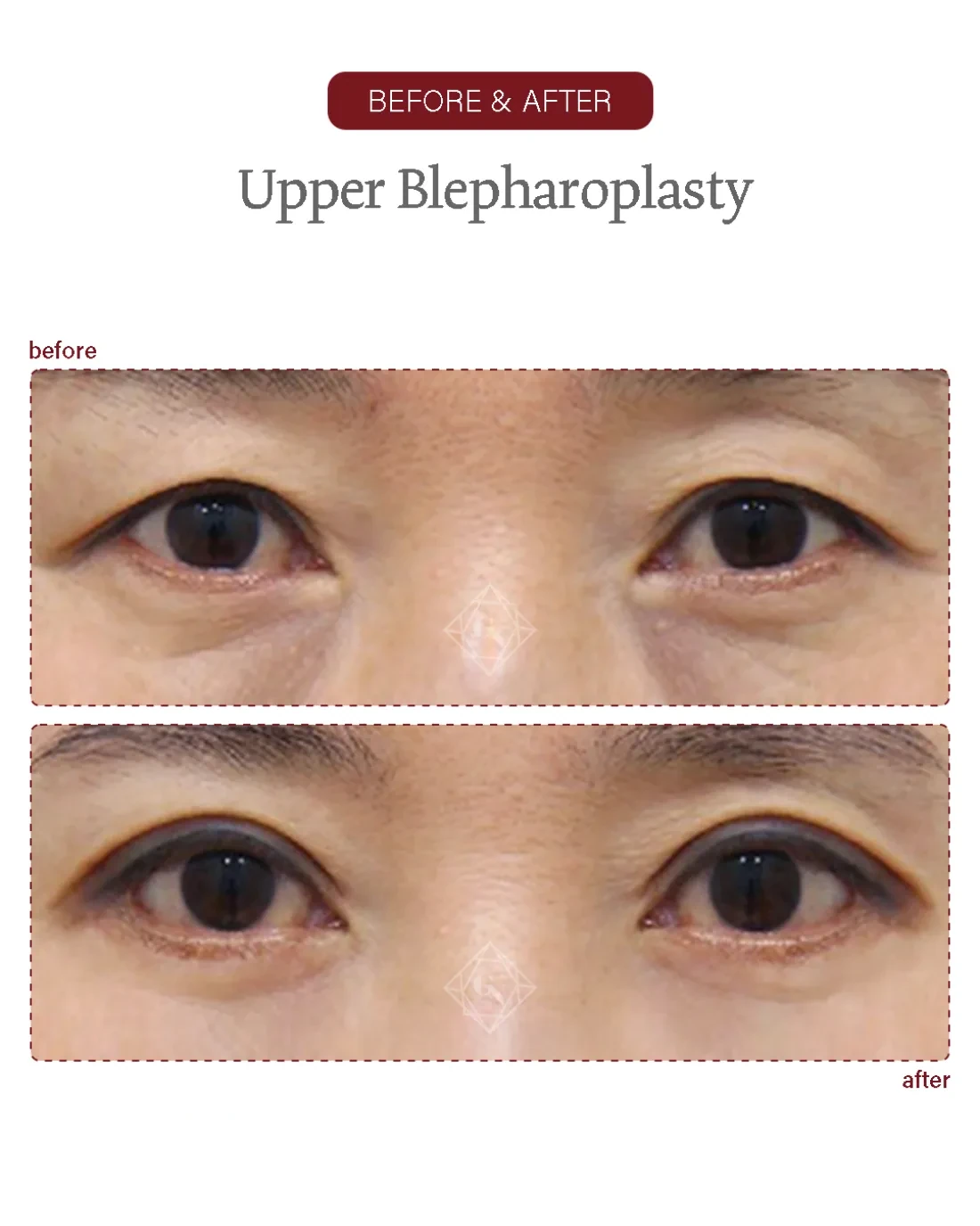 Before and after Upper & Lower Blepharoplasty at Garnet Plastic Surgery, Apgujeong Seoul — actual patient