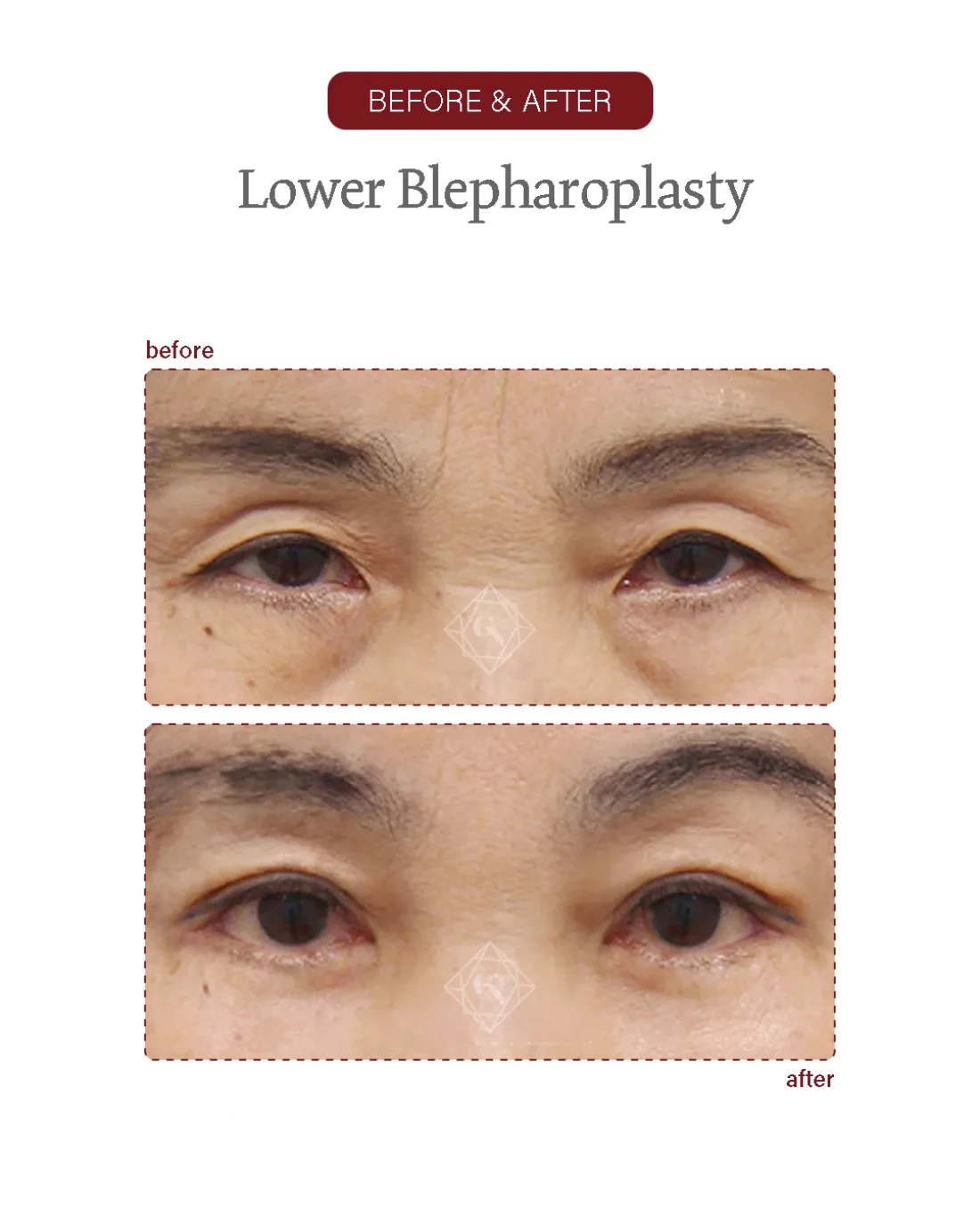 Before and after Upper & Lower Blepharoplasty at Garnet Plastic Surgery, Apgujeong Seoul — actual patient