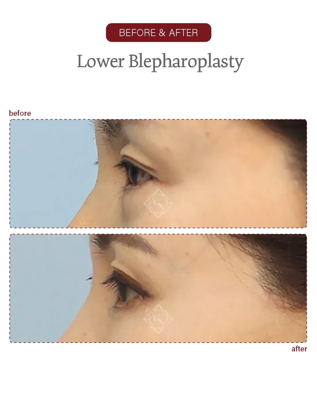 Before and after Upper & Lower Blepharoplasty at Garnet Plastic Surgery, Apgujeong Seoul — actual patient