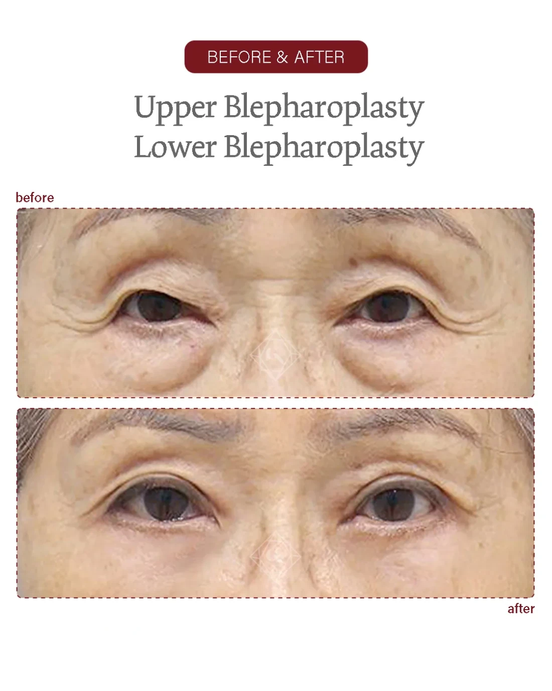 Before and after Upper & Lower Blepharoplasty at Garnet Plastic Surgery, Apgujeong Seoul — actual patient