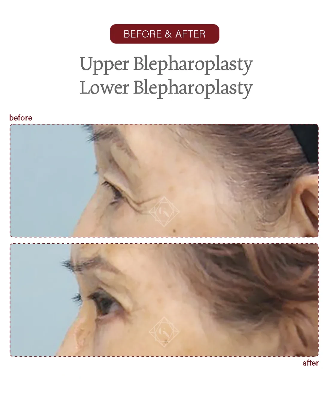 Before and after Upper & Lower Blepharoplasty at Garnet Plastic Surgery, Apgujeong Seoul — actual patient